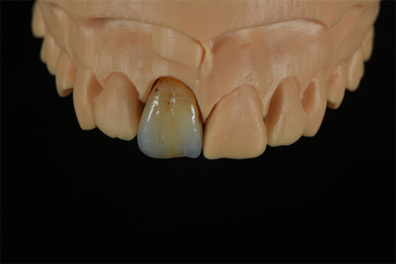 품질  Affordable Zirconia Crowns with Custom Color Staining - China Dental Lab 공장